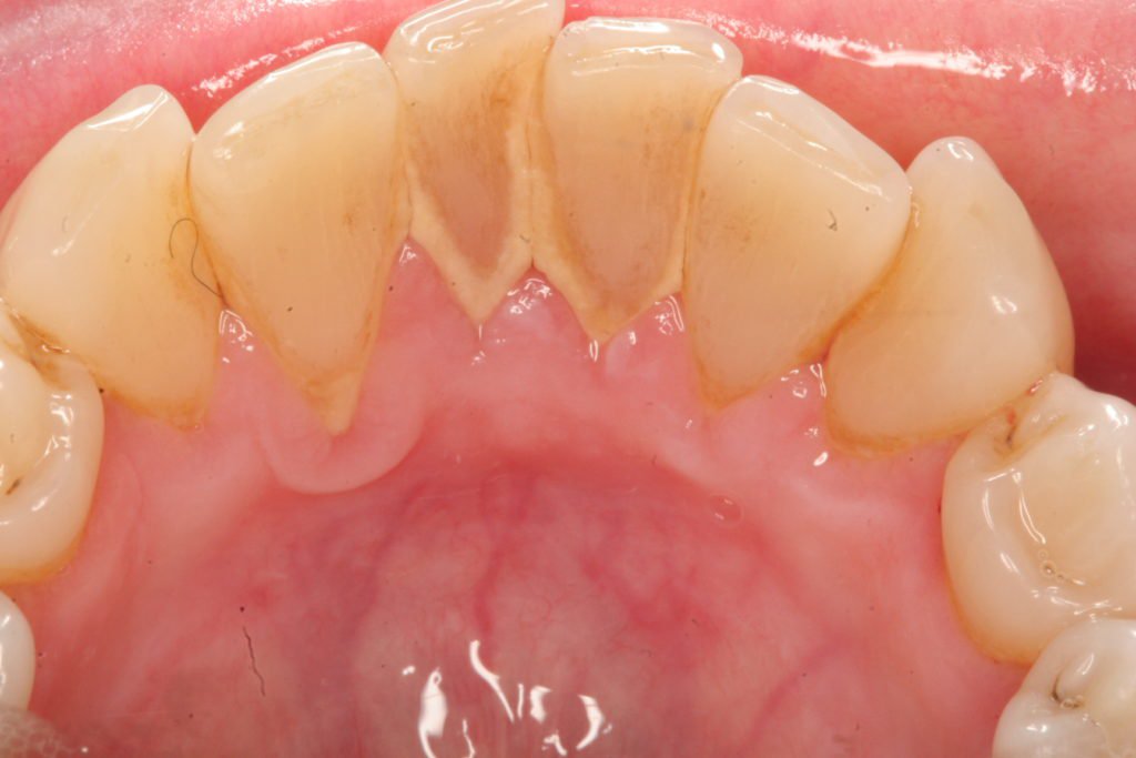 Cao răng hình thành thế nào? | Vinmec