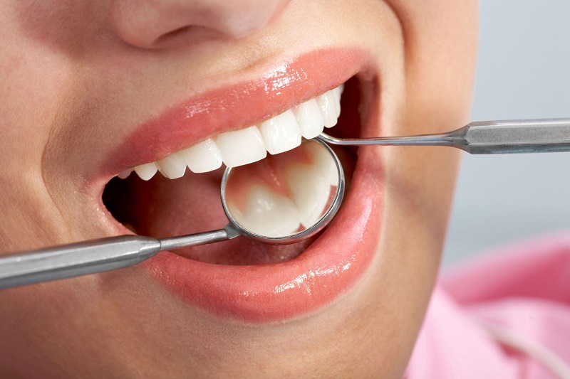 Tất tần tật mọi điều cần biết trước khi đi lấy cao răng | Medlatec