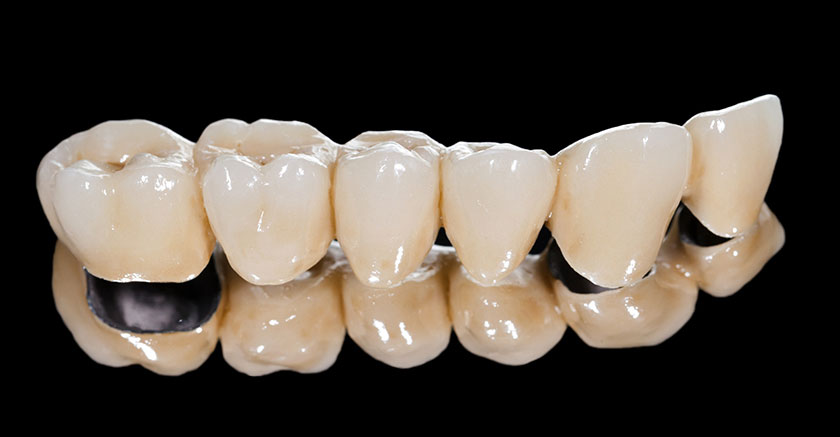 Răng sứ kim loại quý là gì?