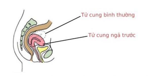 tư thế quan hệ dễ thụ thai với tử cung ngả trước, tử cung ngả trước, tử cung ngả trước là gì, tử cung ngả trước dap=40mm, cổ tử cung ngả trước, tư thế quan hệ 