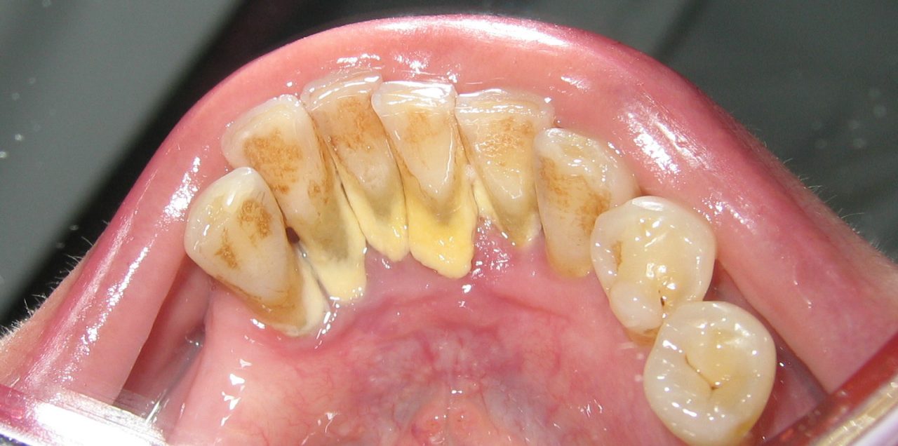 Cao răng nhiều phải làm sao để điều trị? | TCI Hospital