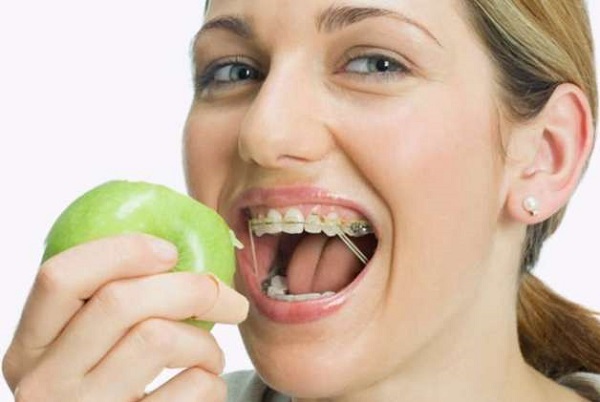 Những thực phẩm cần tránh xa khi đang đeo niềng răng