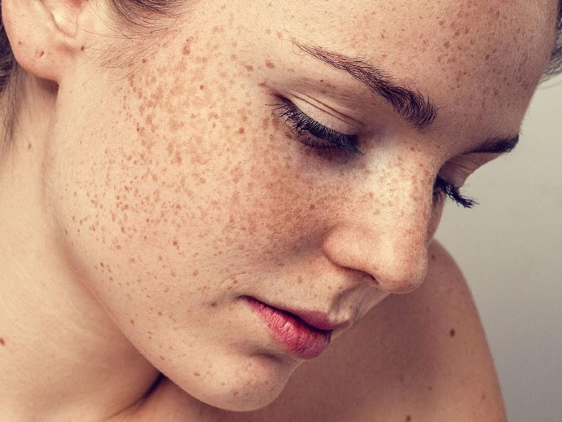 Nám và tàn nhang là những biểu hiện của sự tổn thương sắc tố da rất thường gặp ở người, đặc biệt là đối với phụ nữ khi bước qua tuổi 30