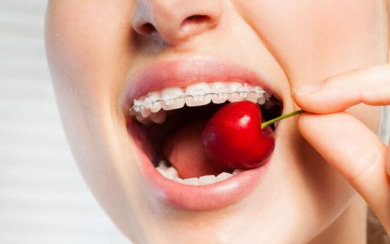 Niềng răng ăn uống thế nào để tránh bị bung mắc cài? Nha khoa Thùy Anh - nhakhoathuyanh