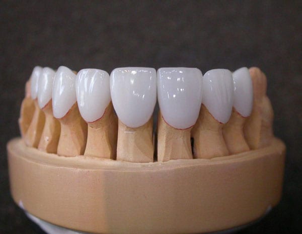 5 điều cần biết về răng sứ Titan - Nha Khoa Gia Đình - Địa chỉ nha khoa uy tín nhất Hà Nội